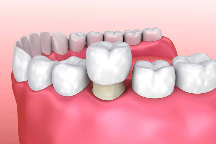 دکتر مهری صفری - متخصص دندانپزشکی ترمیمی و زیبایی - روکش دندان